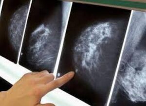 процедура мамографии при онкологии груди у женщин лечение в Израиле